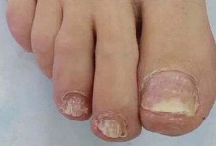The nails were very affected by the fungus
