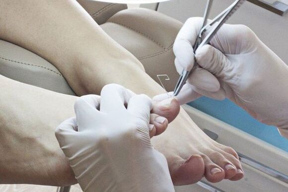 Mechanical elimination of nails affected by fungi