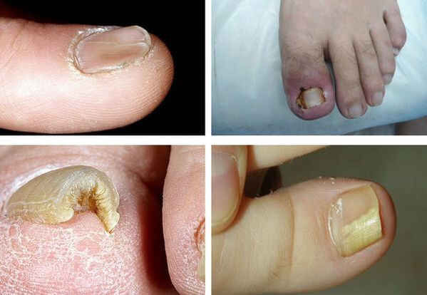 Onychomycosis symptoms on the legs