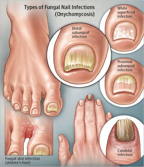 Types of onychomycosis