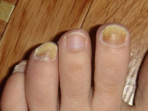 Fungus on the feet with nail damage